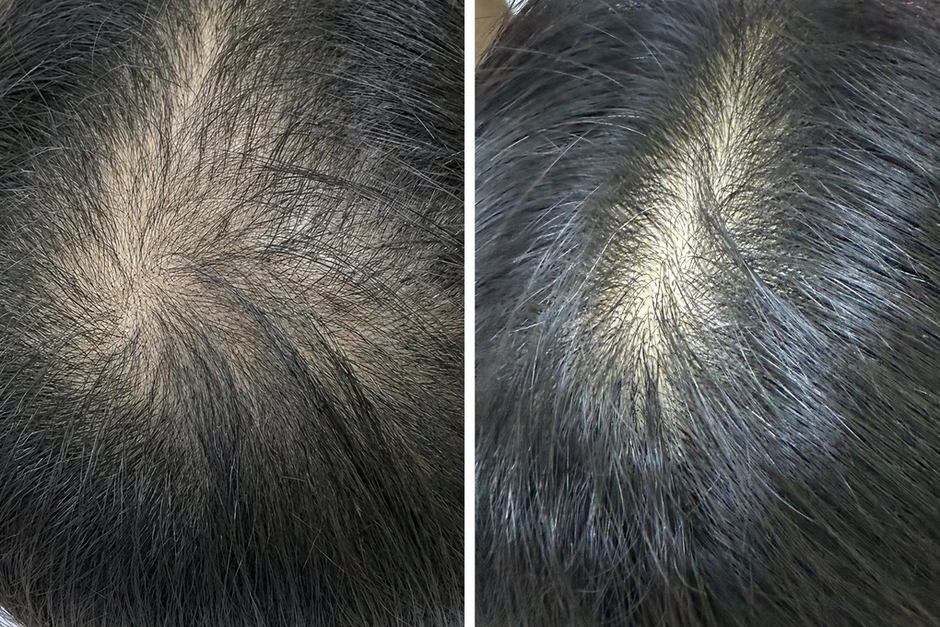 Cô gái hói đầu do hormone nam tăng cao - Báo TinVina Cô gái hói đầu do hormone nam tăng cao - Báo TinVina