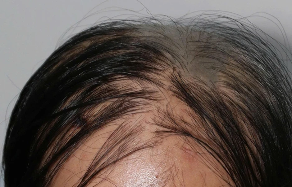 Cô gái mắc bệnh hiếm, rụng hàng trăm sợi tóc mỗi ngày Cô gái mắc bệnh hiếm, rụng hàng trăm sợi tóc mỗi ngày