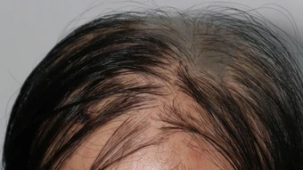 Cô gái mắc bệnh hiếm, rụng hàng trăm sợi tóc mỗi ngày