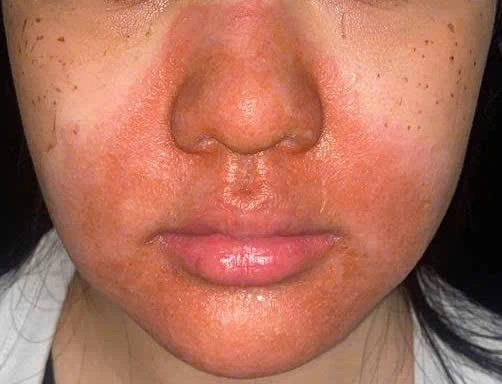 Cô gái trẻ nhập viện với gương mặt đỏ rực, bong tróc sau peel da Cô gái trẻ nhập viện với gương mặt đỏ rực, bong tróc sau peel da