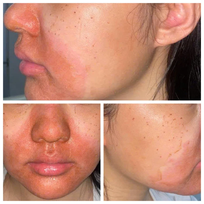 Cô gái trẻ nhập viện với gương mặt đỏ rực, bong tróc sau peel da Cô gái trẻ nhập viện với gương mặt đỏ rực, bong tróc sau peel da