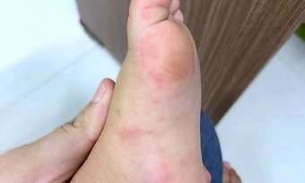 Có nên bôi thuốc vào vết loét của trẻ mắc tay chân miệng? - Báo TinVina