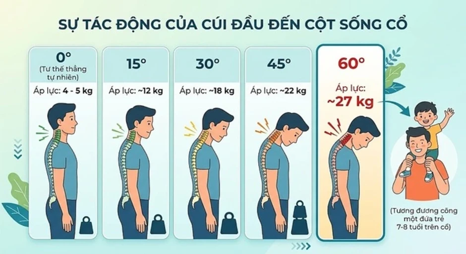 Cổ rùa bởi cúi đầu lướt điện thoại 10 tiếng mỗi ngày Cổ rùa bởi cúi đầu lướt điện thoại 10 tiếng mỗi ngày