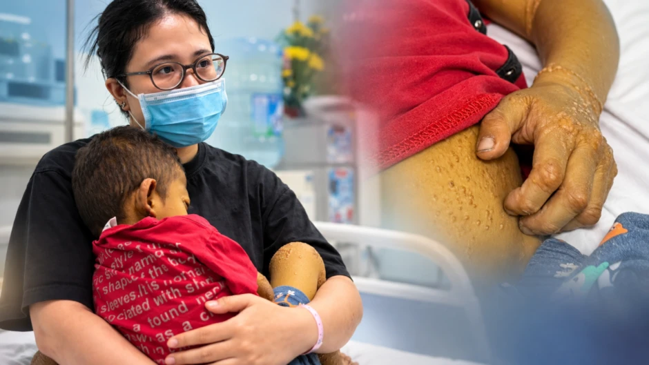 Con 4 tuổi da vàng như nghệ phải thay gan: Mẹ “sốc” khi biết căn bệnh phía sau