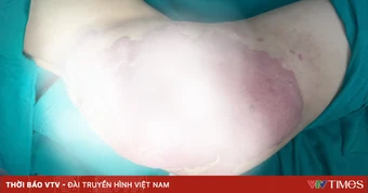 Cứu bé gái 14 năm mang khối u máu nặng 2kg
