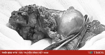 Cứu bệnh nhân viêm ruột thừa ẩn trong lòng manh tràng hiếm gặp