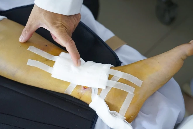 Cứu nam tài xế công nghệ đa chấn thương nặng sau tai nạn trên đường Phạm Ngũ Lão Cứu nam tài xế công nghệ đa chấn thương nặng sau tai nạn trên đường Phạm Ngũ Lão