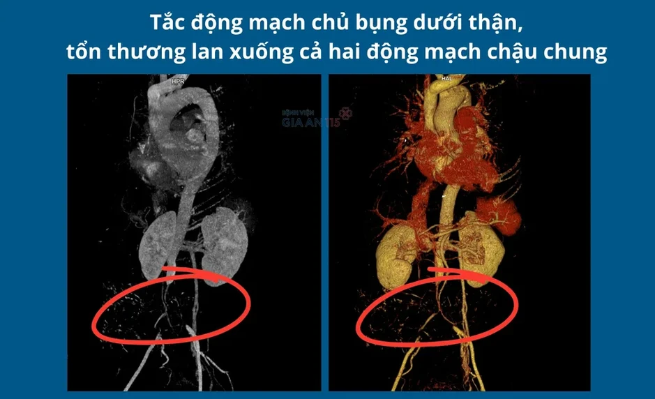 Cứu người phụ nữ Campuchia mắc bệnh lý mạch máu nguy hiểm Cứu người phụ nữ Campuchia mắc bệnh lý mạch máu nguy hiểm