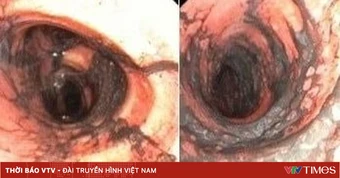 Cứu sống vợ chồng trẻ bị ngạt khói, bỏng khí quản nặng