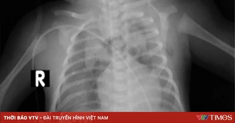 Cứu trẻ sơ sinh suy hô hấp nặng do thiếu surfactant