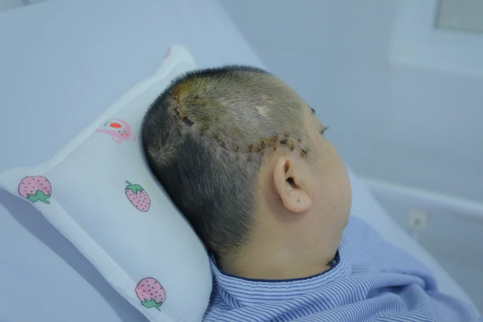 Đang ăn cơm cùng chồng, người phụ nữ 38 tuổi đột ngột vỡ mạch máu não Đang ăn cơm cùng chồng, người phụ nữ 38 tuổi đột ngột vỡ mạch máu não