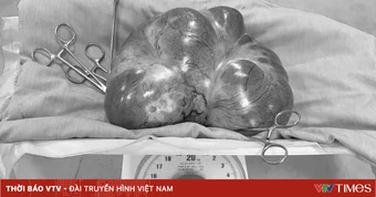 Dấu hiệu cảnh báo u buồng trứng ở phụ nữ lớn tuổi