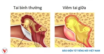 Đau tai, ù tai chớ chủ quan: Nhận biết 3 dạng viêm tai thường gặp