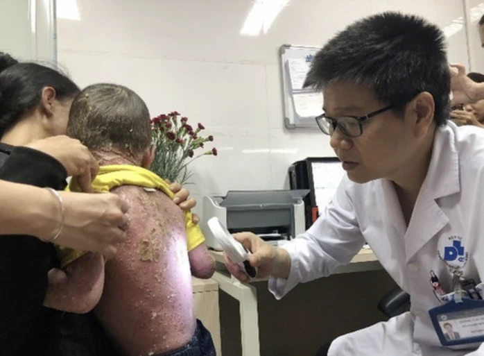 Đề xuất BHYT chi trả 50-70% thuốc sinh học điều trị vảy nến