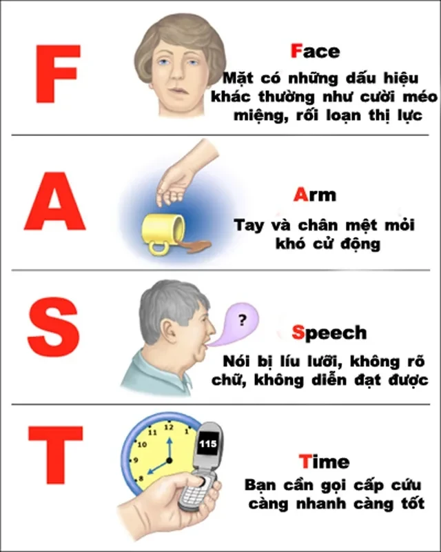 Đề xuất người trên 40 tuổi được sàng lọc nguy cơ đột quỵ Đề xuất người trên 40 tuổi được sàng lọc nguy cơ đột quỵ
