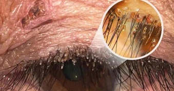 Đi khám vì ngứa mắt, phát hiện rận mu bám chi chít trên lông mi