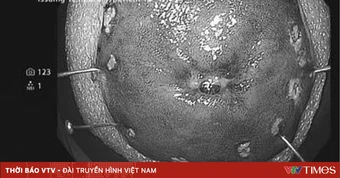 Đi khám vì táo bón kéo dài, phát hiện mắc hai loại ung thư