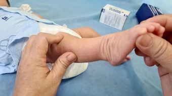 Dị tật chân khoèo có di truyền? - Báo TinVina