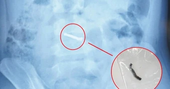 Dị vật nam châm "xếp hàng dài", gây thủng ruột bé trai 5 tuổi
