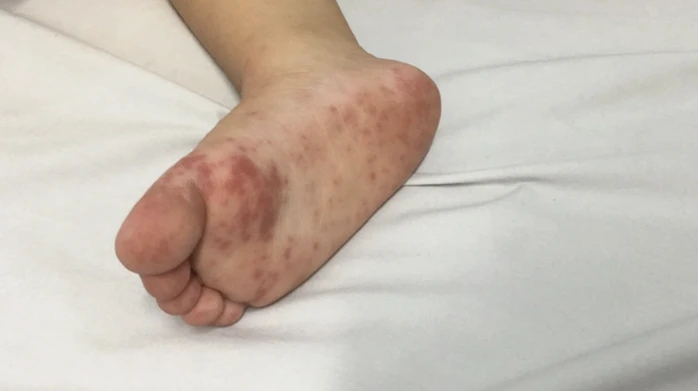 Dịch tay chân miệng “nóng” trở lại, trẻ nhỏ đối mặt nguy cơ biến chứng nặng Dịch tay chân miệng “nóng” trở lại, trẻ nhỏ đối mặt nguy cơ biến chứng nặng