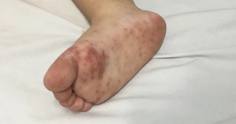 Dịch tay chân miệng “nóng” trở lại, trẻ nhỏ đối mặt nguy cơ biến chứng nặng