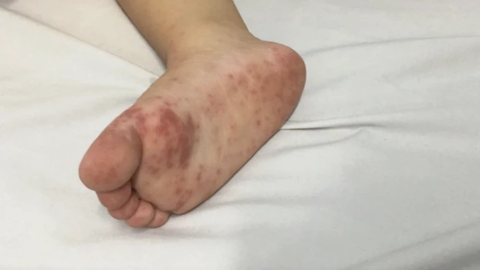 Dịch tay chân miệng tăng nhanh, ghi nhận 8 ca tử vong tại phía Nam Dịch tay chân miệng tăng nhanh, ghi nhận 8 ca tử vong tại phía Nam
