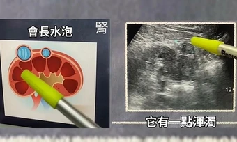 Điểm mờ trên siêu âm bụng tiết lộ khối u ác tính ở thận