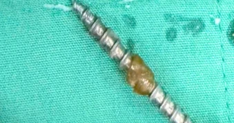 Đinh vít sắc nhọn nằm trong bụng bé gái 30 tháng tuổi