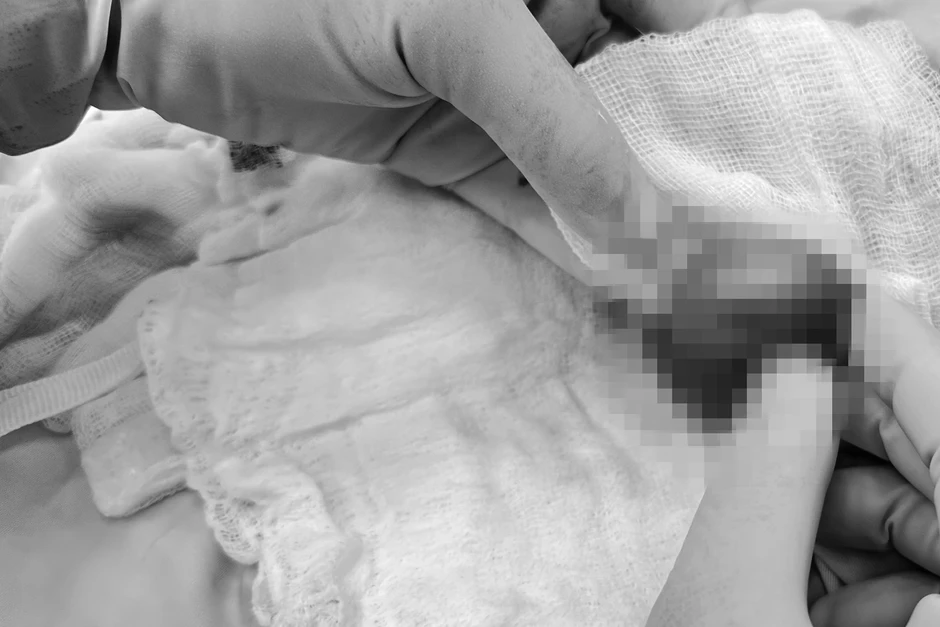 Đột ngột đau vùng kín lúc nửa đêm, chàng trai ở TPHCM suýt mất tinh hoàn Đột ngột đau vùng kín lúc nửa đêm, chàng trai ở TPHCM suýt mất tinh hoàn