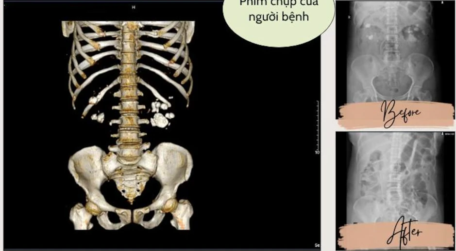 Đột quỵ gia tăng: Nghiên cứu Mỹ hé lộ thủ phạm mới Đột quỵ gia tăng: Nghiên cứu Mỹ hé lộ thủ phạm mới