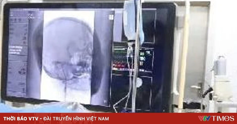Đột quỵ ở người trẻ gia tăng: Đừng chủ quan với cơn đau đầu bất thường Đột quỵ ở người trẻ gia tăng: Đừng chủ quan với cơn đau đầu bất thường