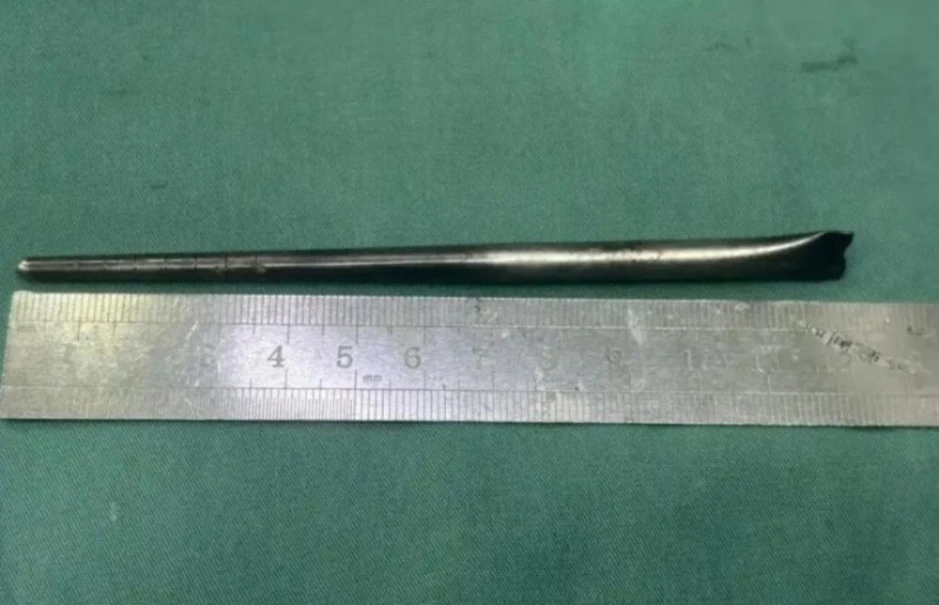 Đũa kim loại 12 cm trong cổ họng người đàn ông suốt 8 năm Đũa kim loại 12 cm trong cổ họng người đàn ông suốt 8 năm