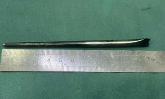 Đũa kim loại 12 cm trong cổ họng người đàn ông suốt 8 năm