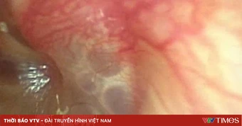 Đừng chủ quan khi trẻ đau tai sau đi bơi, tắm biển