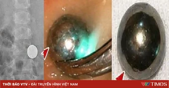 Đừng chủ quan với đồ chơi bi nam châm