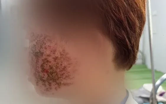 Eczema Herpeticum - đừng nhầm với viêm da thông thường