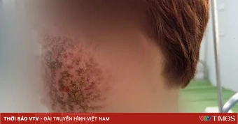 Eczema Herpeticum - đừng nhầm với viêm da thông thường