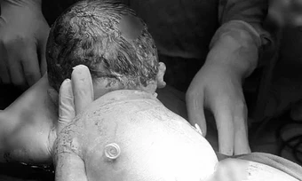 Em bé chào đời với 'đôi cánh nhỏ' trên lưng