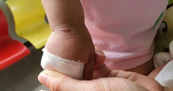 Gánh nặng bệnh hiếm - chẩn đoán khó, chi phí điều trị cao