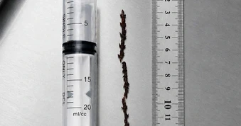 Gắp dị vật dài 11cm có nhiều gai trong phế quản bệnh nhân