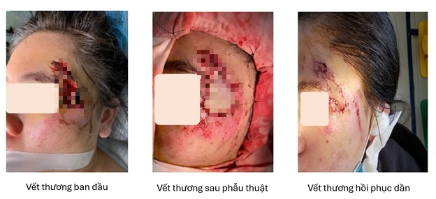 Ghép da thành công cho cô gái bị hoại tử vùng mặt sau tai nạn giao thông Ghép da thành công cho cô gái bị hoại tử vùng mặt sau tai nạn giao thông