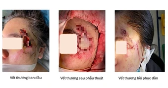 Ghép da thành công cho cô gái bị hoại tử vùng mặt sau tai nạn giao thông