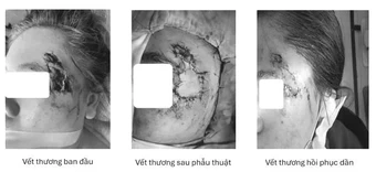 Ghép da thành công cho người bệnh bị hoại tử vùng mặt sau tai nạn giao thông