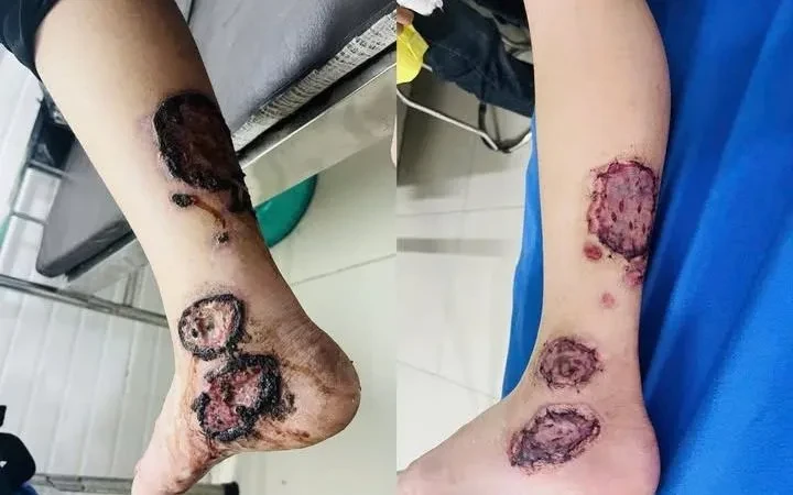 Ghép da tự thân - giải pháp hiệu quả trong điều trị bỏng và khuyết da Ghép da tự thân - giải pháp hiệu quả trong điều trị bỏng và khuyết da