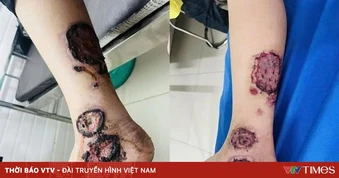 Ghép da tự thân - giải pháp hiệu quả trong điều trị bỏng và khuyết da