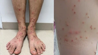 Gia tăng ca bệnh sẩn ngứa do bọ chét, nhiều người tự điều trị sai cách