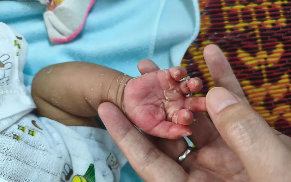 Giang mai bẩm sinh: Đừng nhầm với bệnh ngoài da Giang mai bẩm sinh: Đừng nhầm với bệnh ngoài da