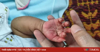 Giang mai bẩm sinh: Đừng nhầm với bệnh ngoài da