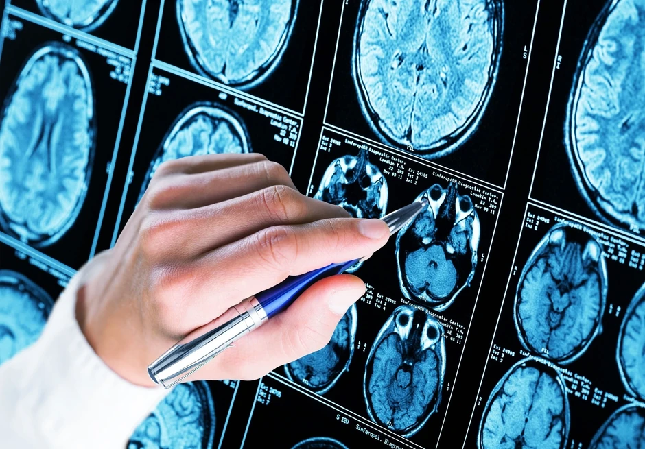 Giới y học sửng sốt phát hiện chàng trai 19 tuổi mắc Alzheimer
