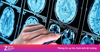 Giới y học sửng sốt phát hiện chàng trai 19 tuổi mắc Alzheimer